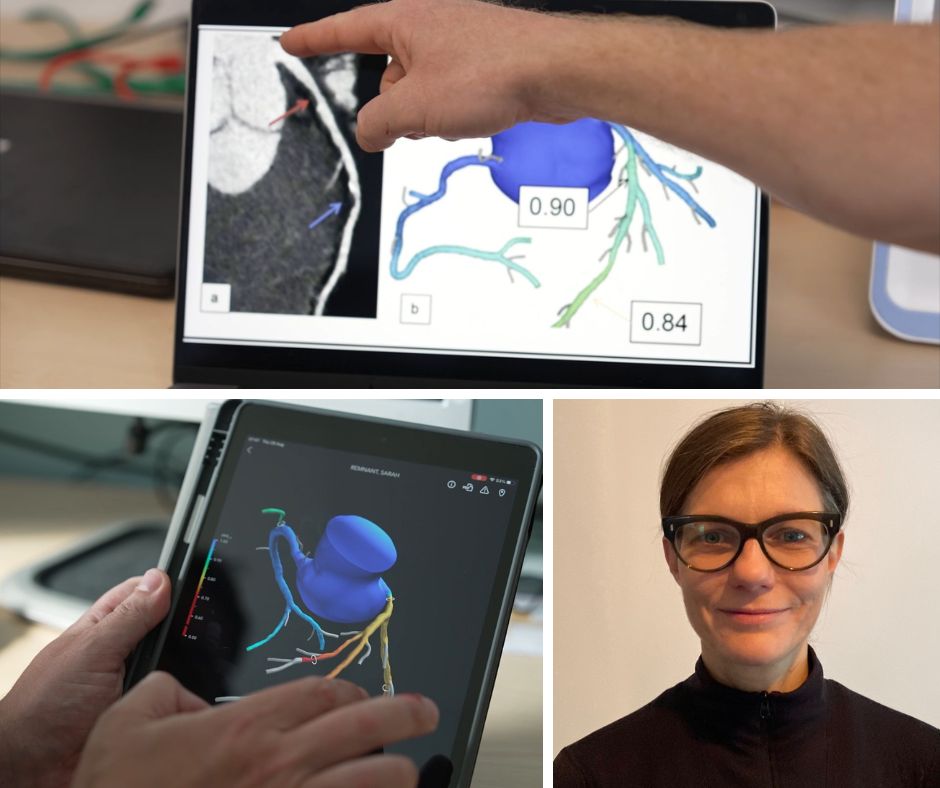 The top image shows a picture of the 3D heart scan on a laptop screen. The image on the bottom left shows the Heartflow technology on an eletronic tablet. Bottom right is a headshot of Dr Anna Beattie